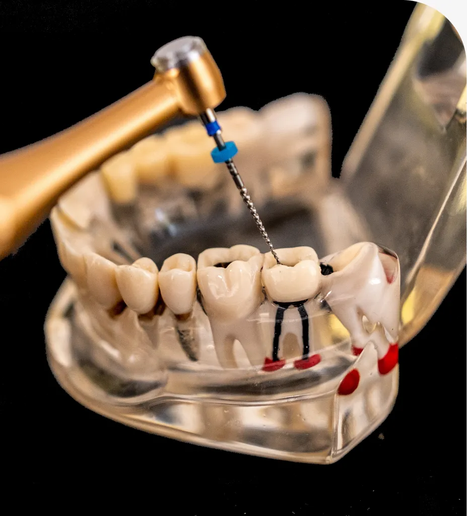 Tooth Extractions in Exton, PA: A Patient Guide - Comfort Dental Care