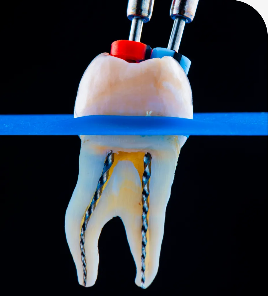 Root Canal Therapy in Exton, PA: What Patients Should Know - Comfort Dental Care